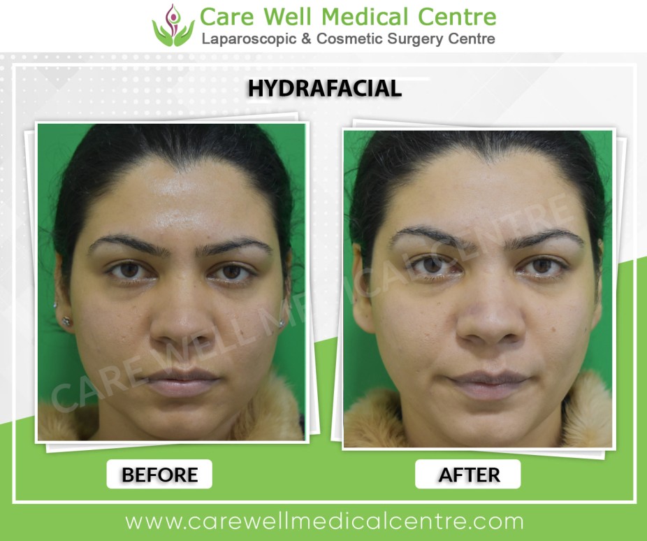 HydraFacial Treatment Before And After Results