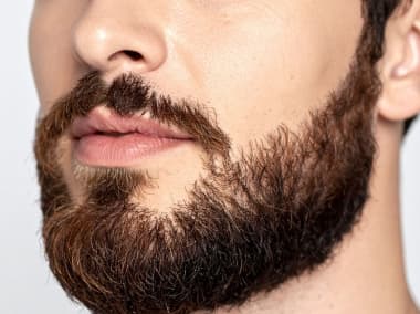 Beard transplant and facial hair restoration