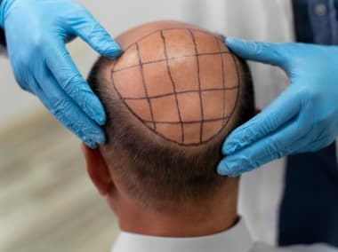 Hair transplant and restoration
