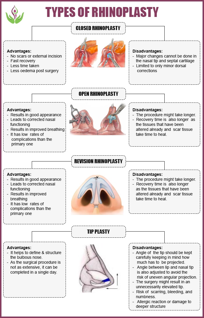 types of rhinoplasty