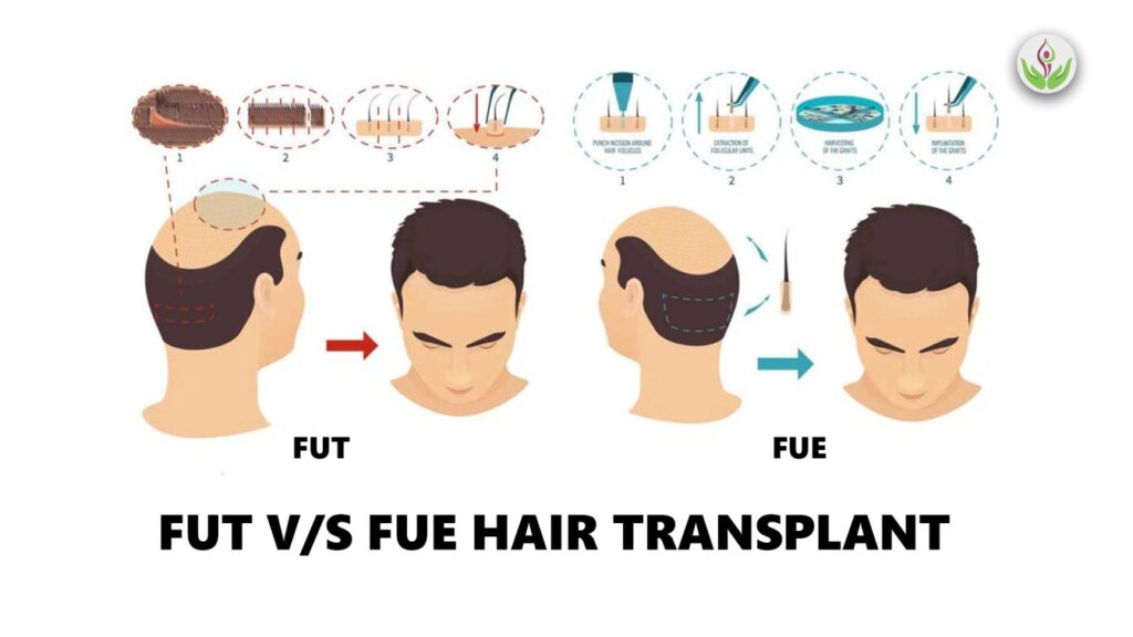 FUT hair transplant in delhi, FUE hair transplant in delhi, fut treatment in delhi, fue treatment in delhi, fut treatment cost in delhi, fue treatment cost in delhi,