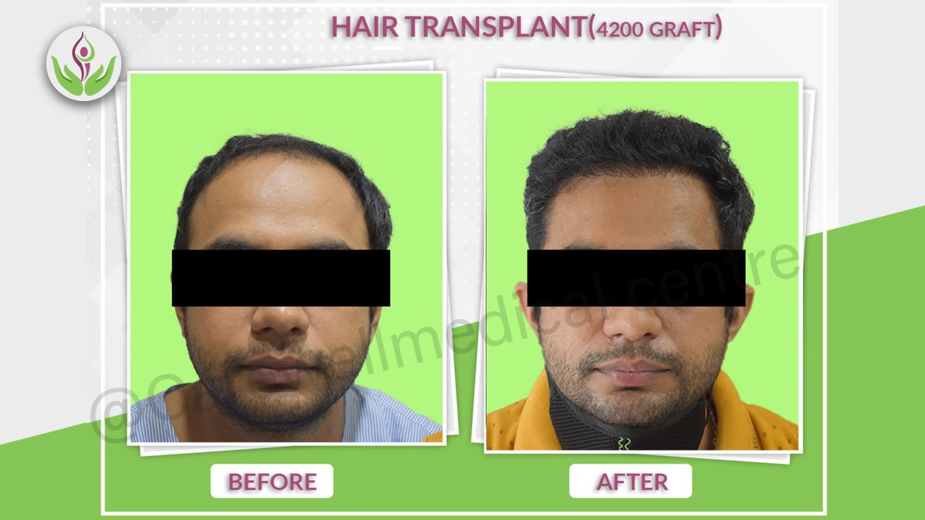 Hair Transplant Before And After Results, before and after hair transplant results, hair transplant cost in delhi,best hair transplant result in care well medical centre