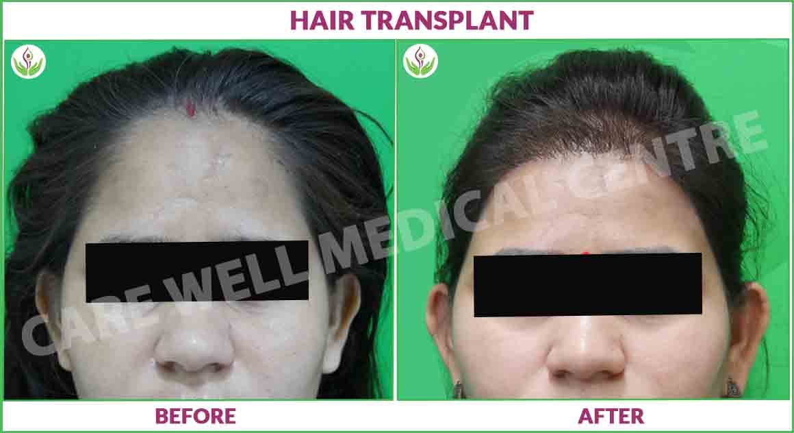 female hair transplant before and after photo