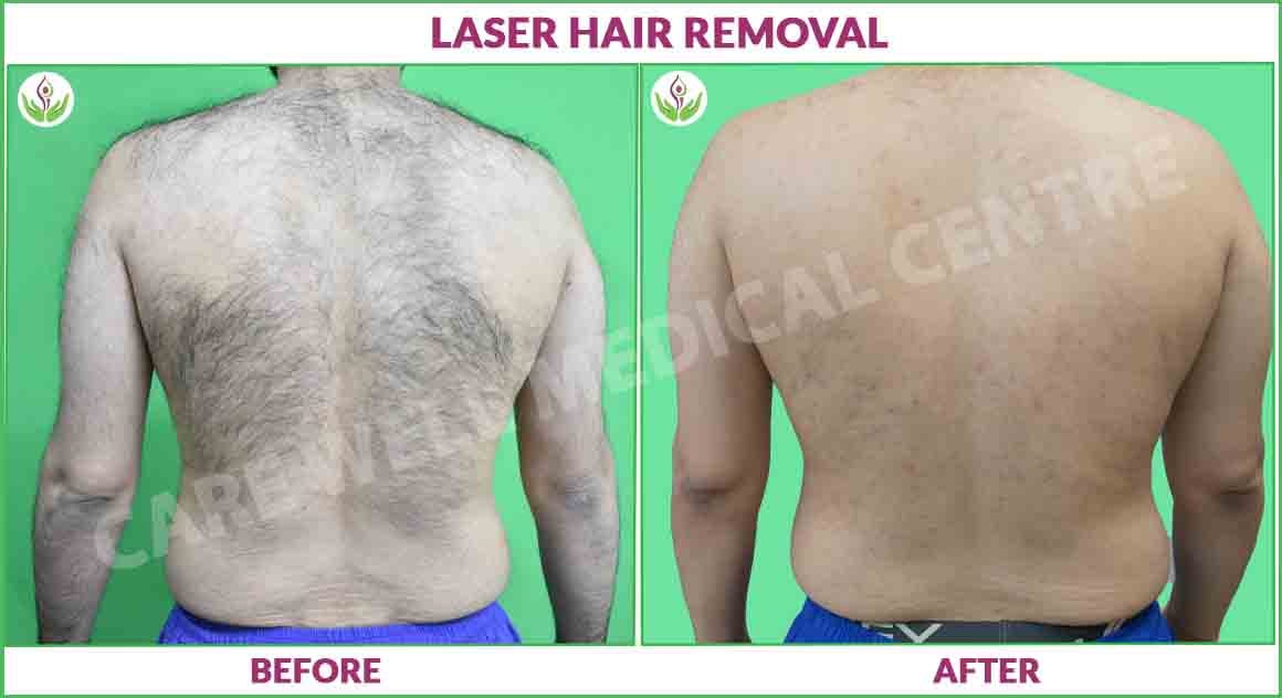 male back laser hair removal before and after photo