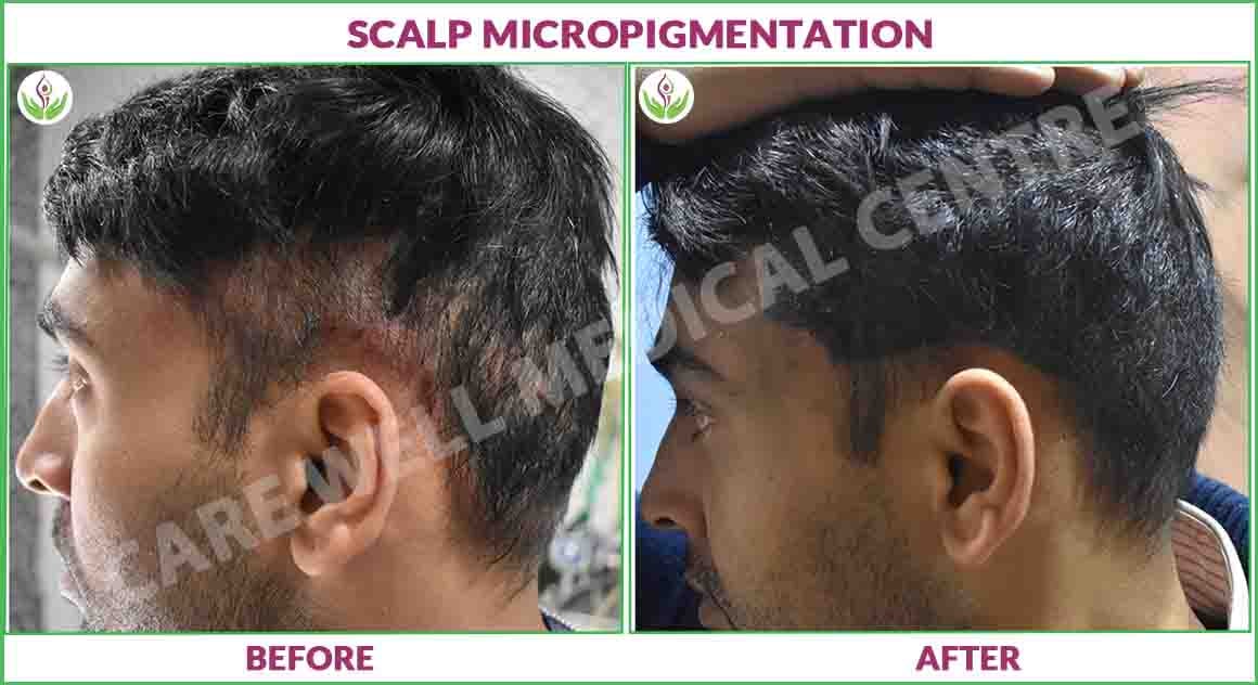 scalp micropigmentation before and after Result