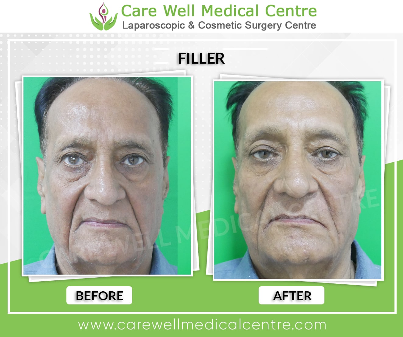 dermal fillers treatment before and after results