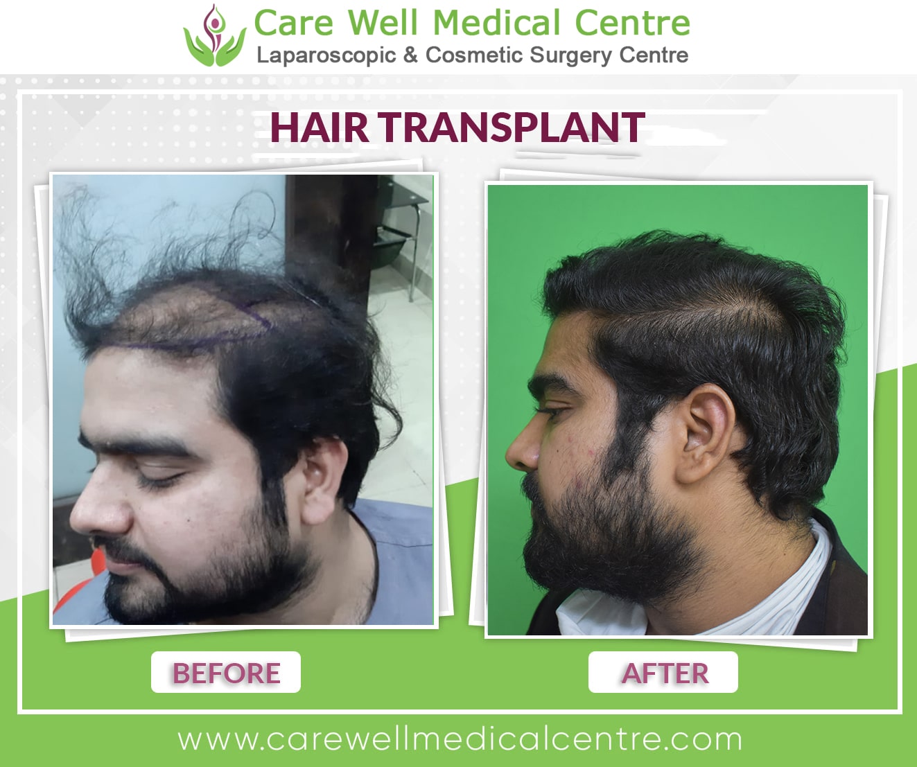 hair transplant before and after result in Faridabad