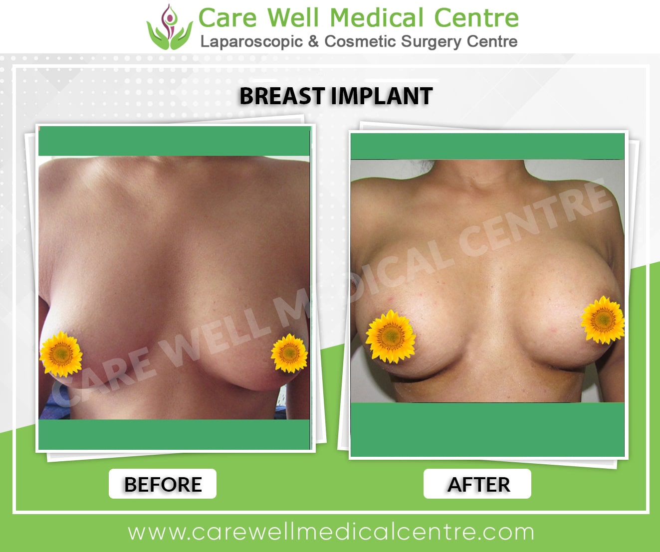 silicone breast implants before and after photo