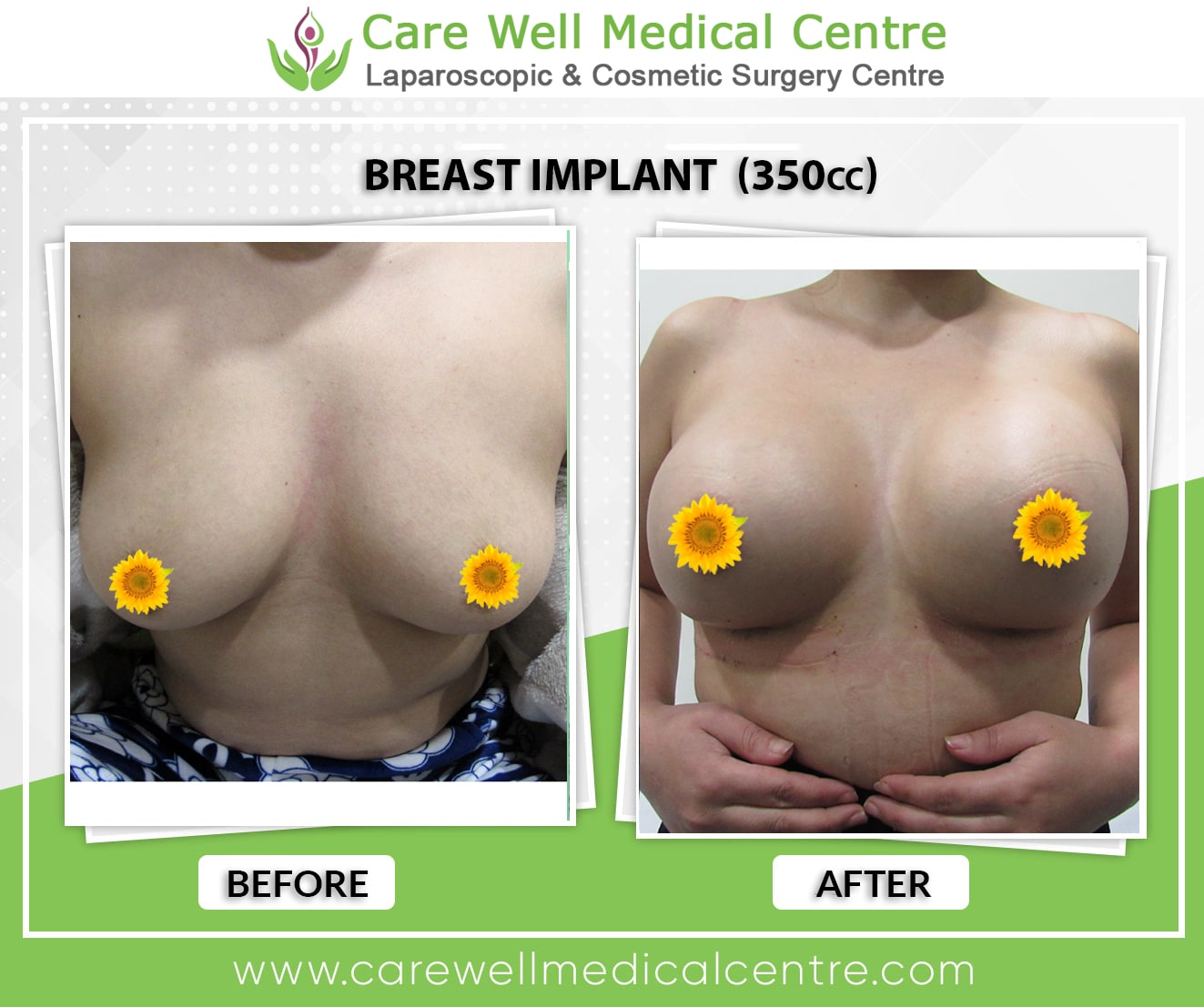 silicone breast implants before and after photos