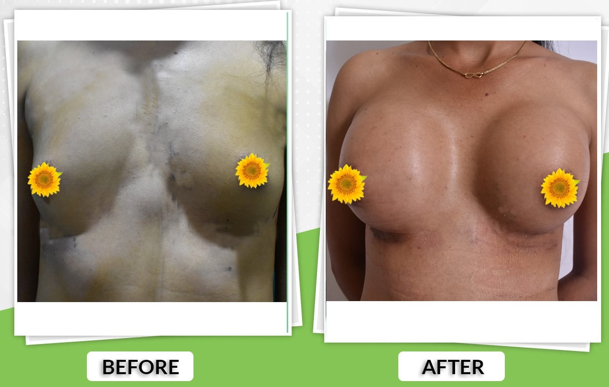 Breast Augmentation before and after result