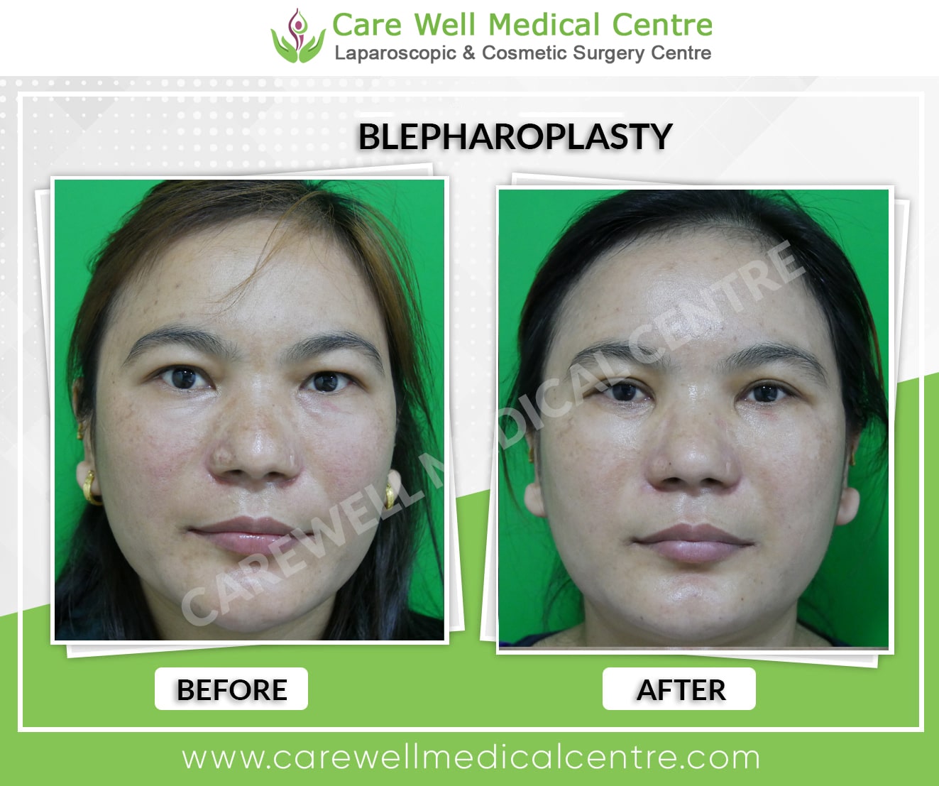 A comparison photo showing the transformation of double eyelids before and after surgery.