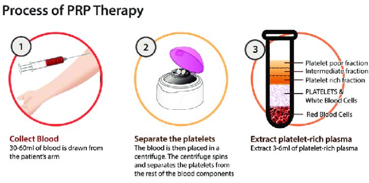 platelet-rich plasma (PRP) therapy procedure for vampire facelift