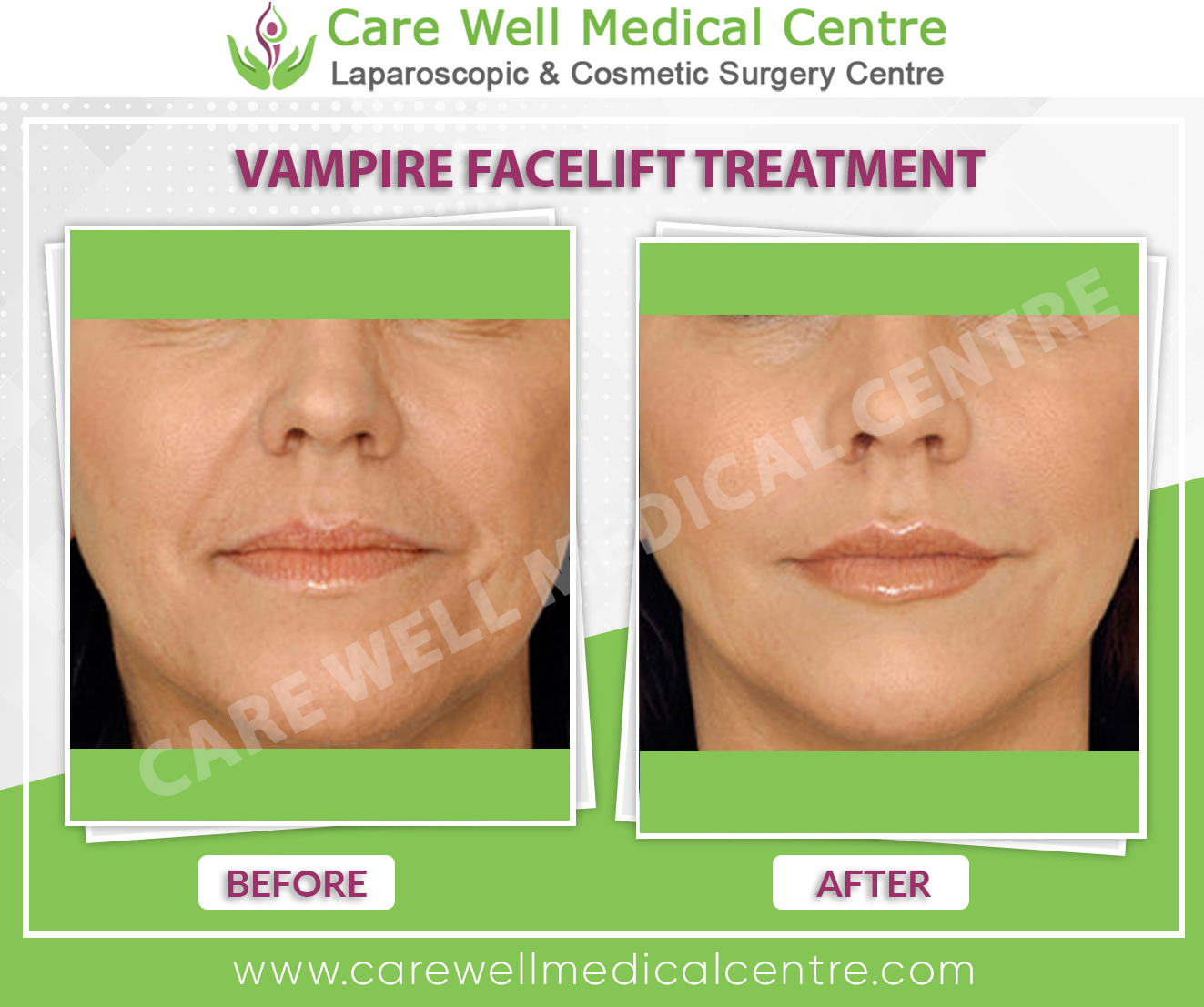 vampire facelift before and after photo