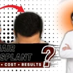 What is FUE Hair Transplant