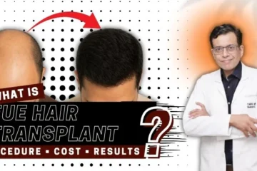 What is FUE Hair Transplant