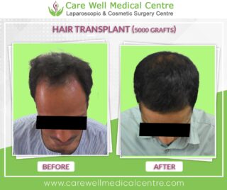 5000 Graft hair Transplant Before and after results photo