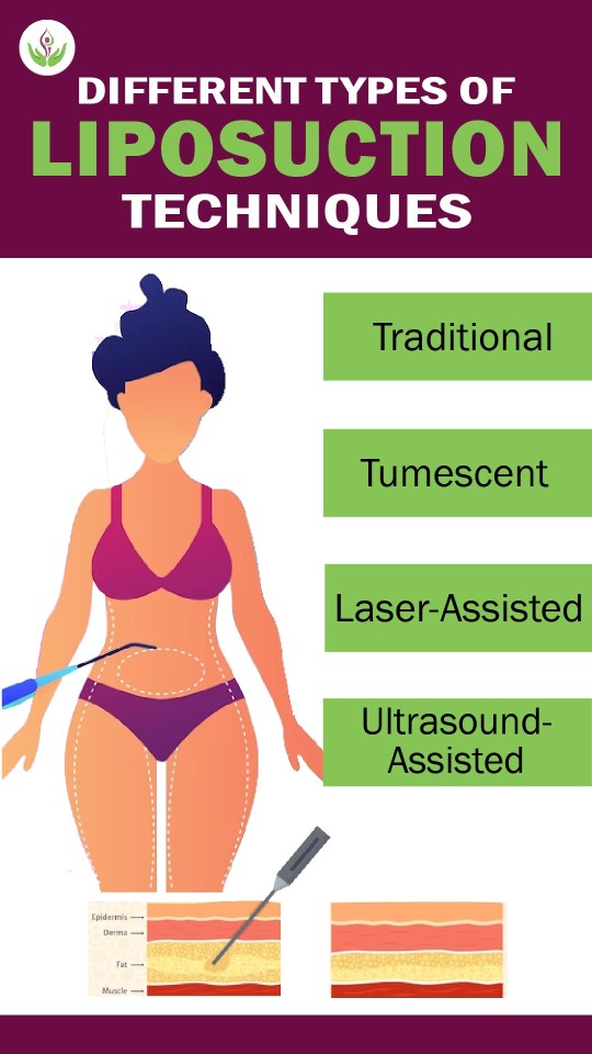 Different Types of Liposuction Techniques