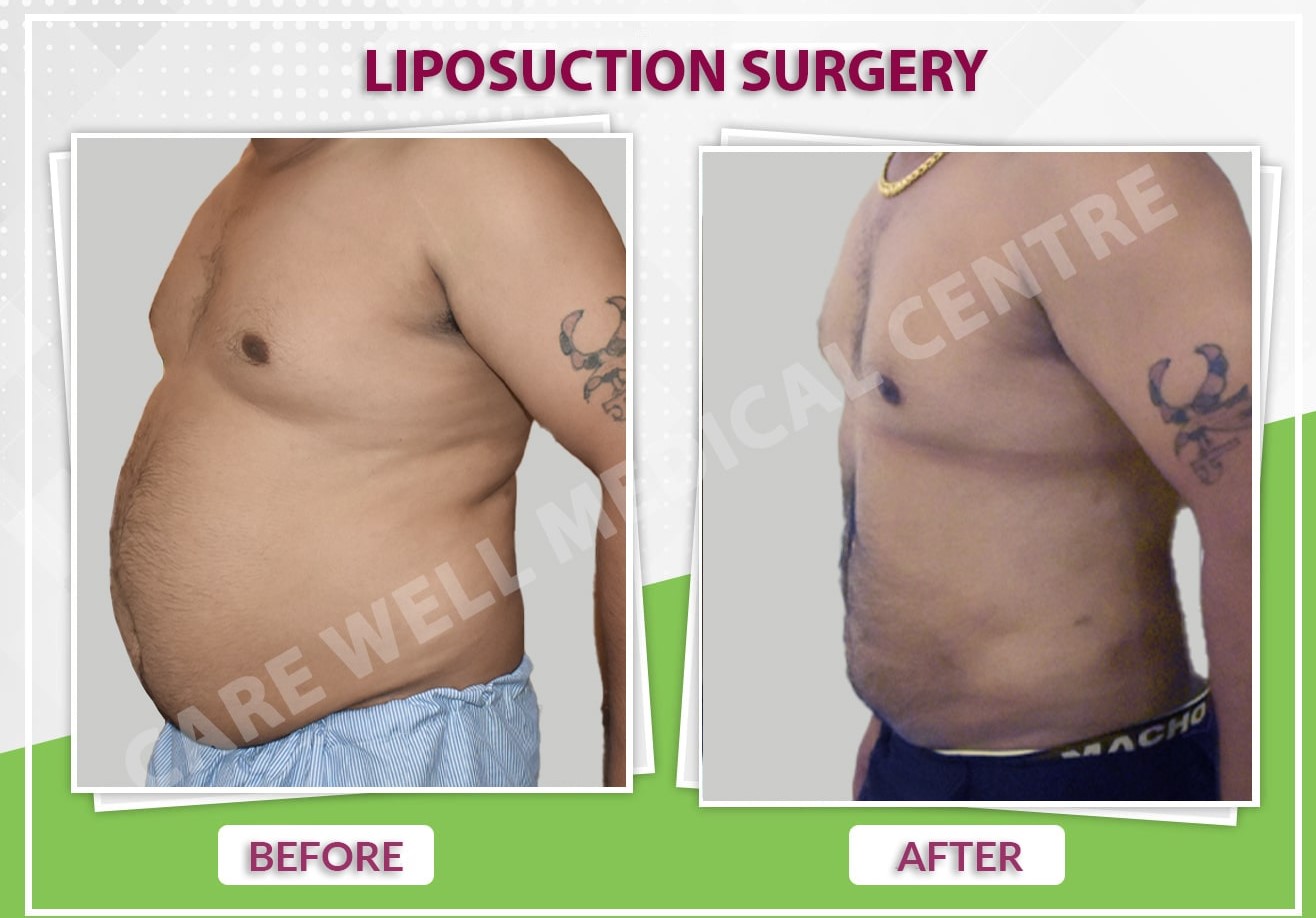 liposuction surgery before and after result