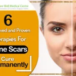 How to Cure Acne Permanently: Proven and Approved Therapies