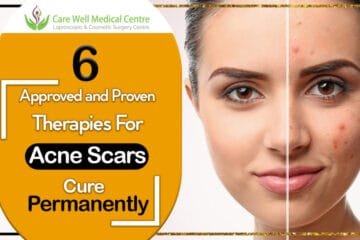 How to Cure Acne Permanently: Proven and Approved Therapies