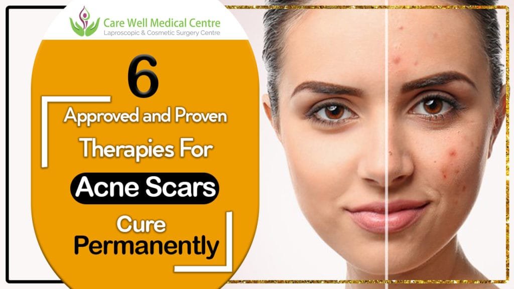 How to Cure Acne Permanently: Proven and Approved Therapies