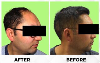 Hair Transplant Before and After Results