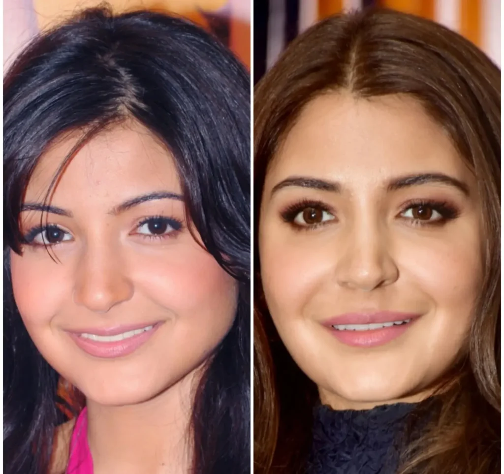 Anushka Sharma botox treament before and after image