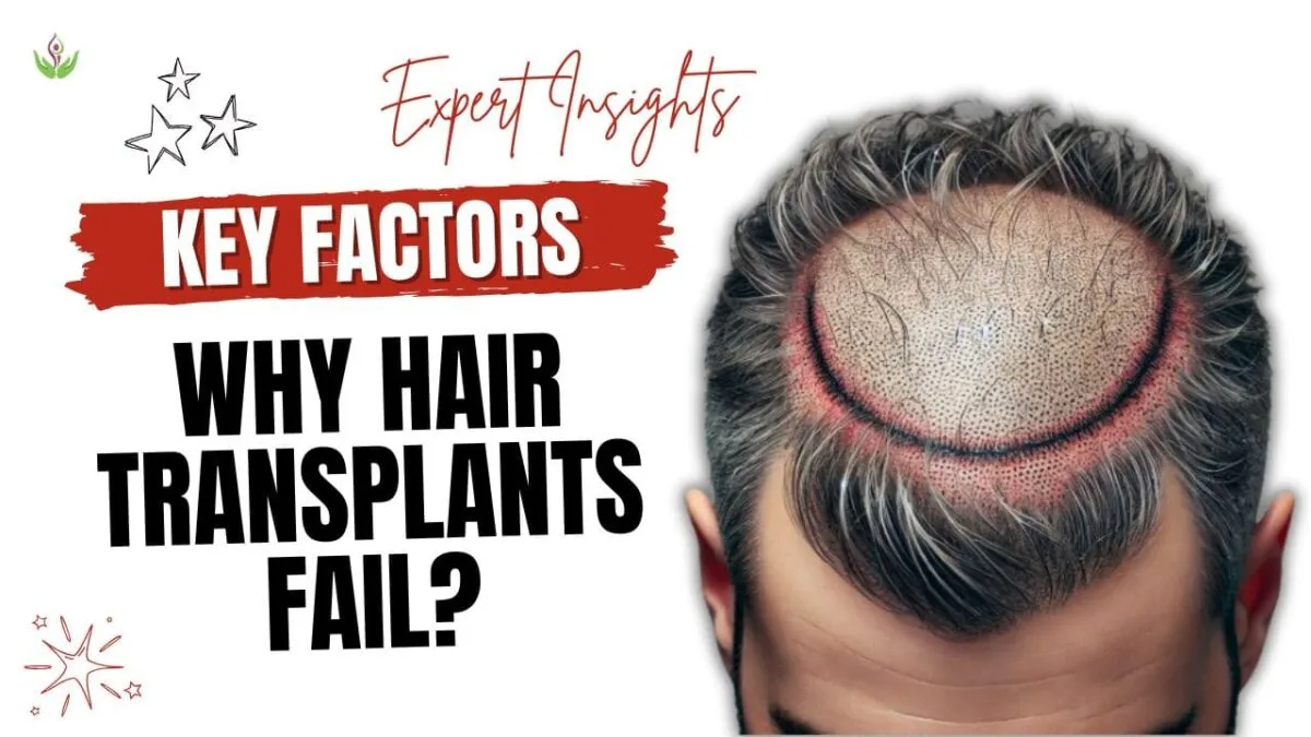 Key Factors That Lead to Failed Hair Transplantation