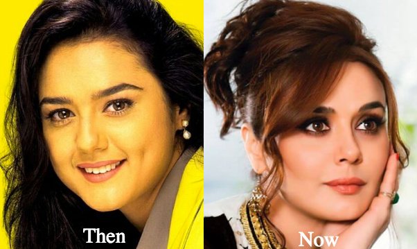 preity zinta nose job before and after result
