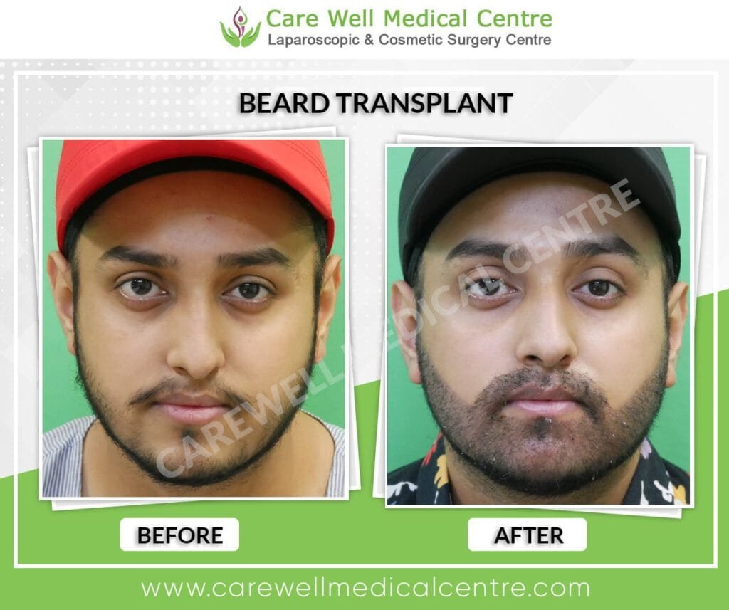 Natural beard transplant results with improved density