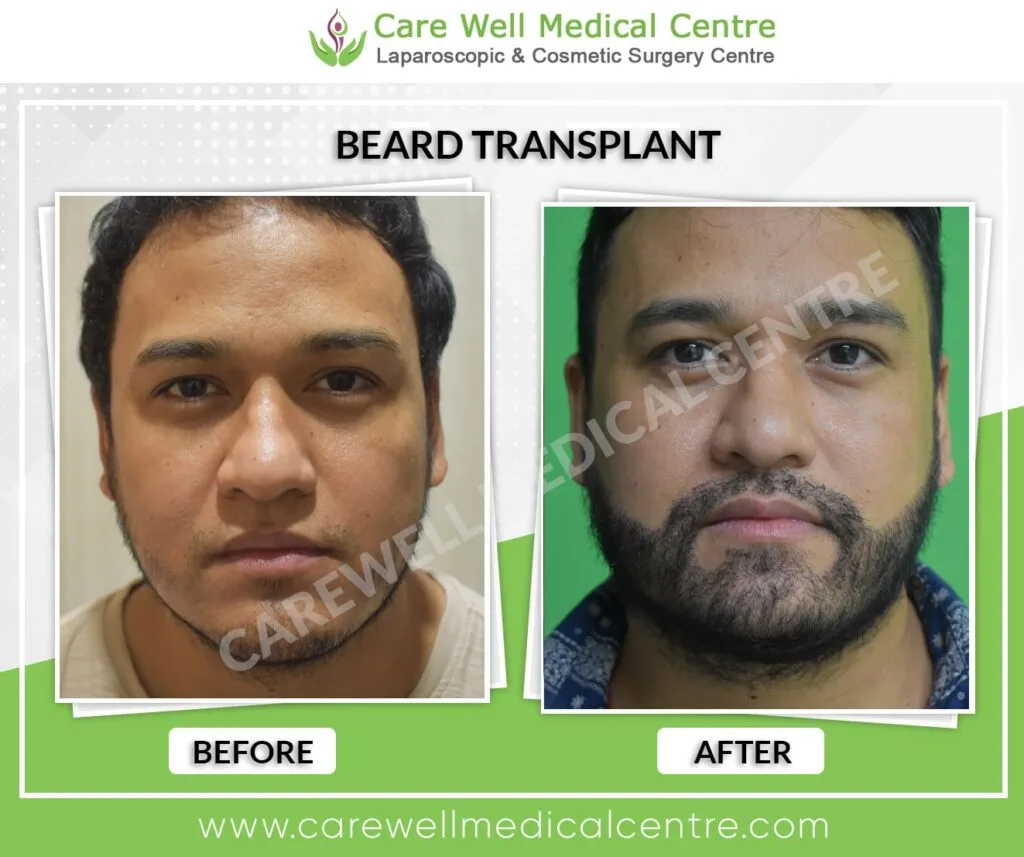 Beard transplant growth progress at 9 months front view