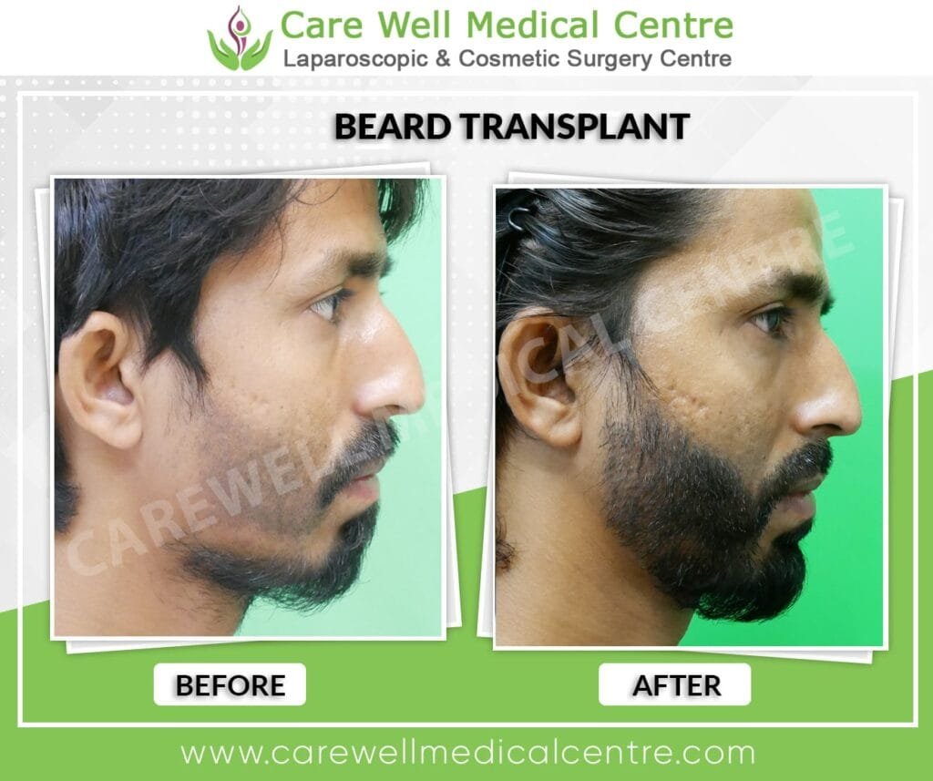 Beard transplant before and after results after 12 months