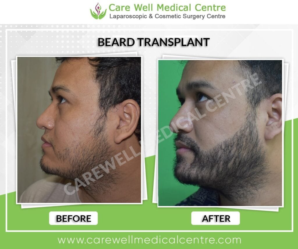 Beard transplant growth progress at 9 months