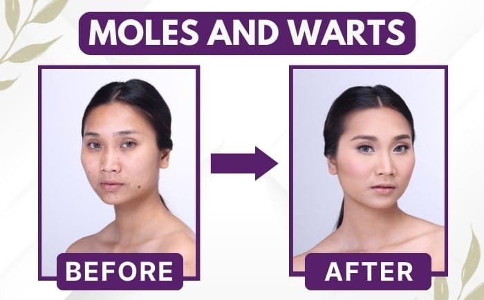 Before–after of laser moles & warts removal in Delhi
