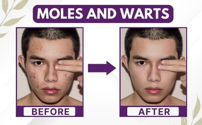 Results of laser moles & warts removal treatment in Delhi