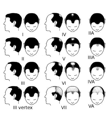 Norwood scale showing stages of male pattern baldness.