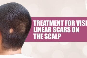 New Treatment for Visible Linear Scars on the Scalp