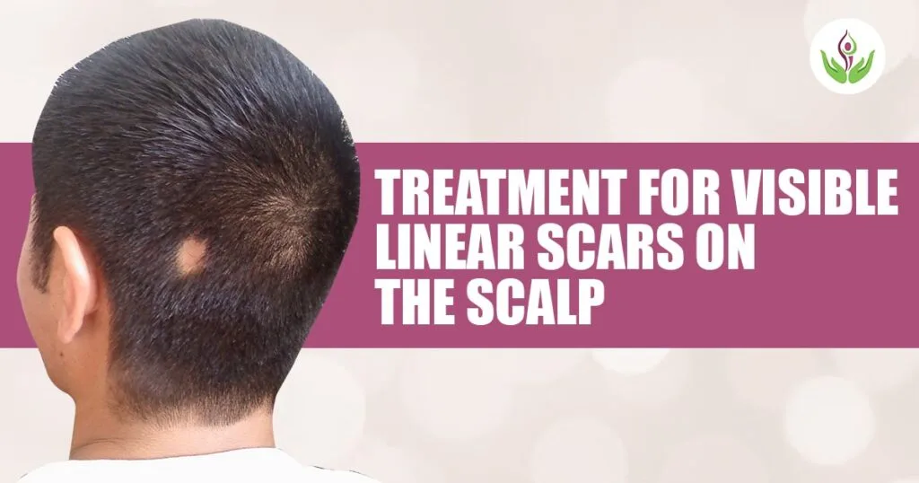 New Treatment for Visible Linear Scars on the Scalp
