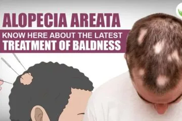 Alopecia Areata Latest Treatment of Baldness in 2024