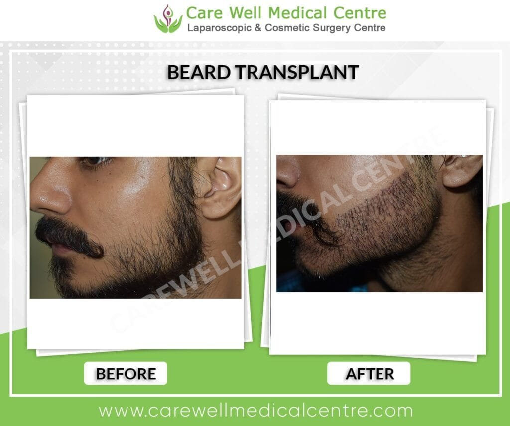 Jawline beard transplant before and after outcome