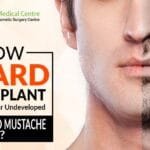 How Beard Transplant Can Solve Your Undeveloped Beard and Mustache Problem?