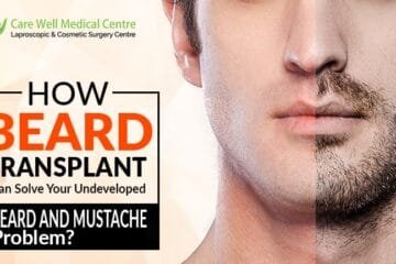 How Beard Transplant Can Solve Your Undeveloped Beard and Mustache Problem?