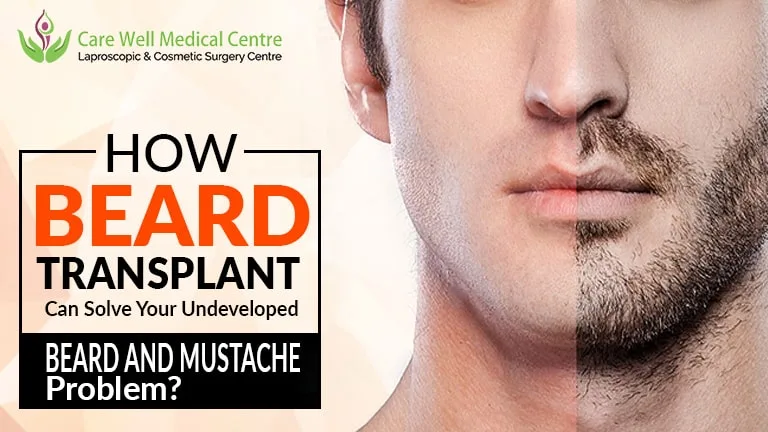 How Beard Transplant Can Solve Your Undeveloped Beard and Mustache Problem?