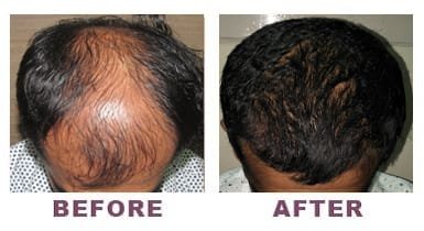 Patient’s hair loss treatment Before and After Photo