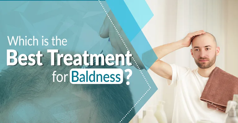 Which is the Best Treatment for Baldness?