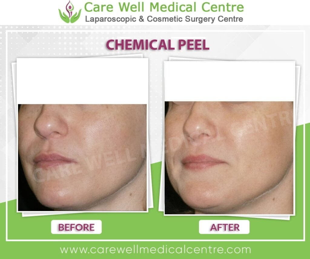 Chemical peel before and after skin brightening treatment Delhi