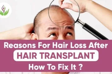Know Reasons For Hair Loss After Hair Transplant – How To Fix It?