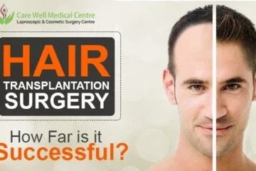 How Really Successful is Hair Transplant Surgery? Then Decide
