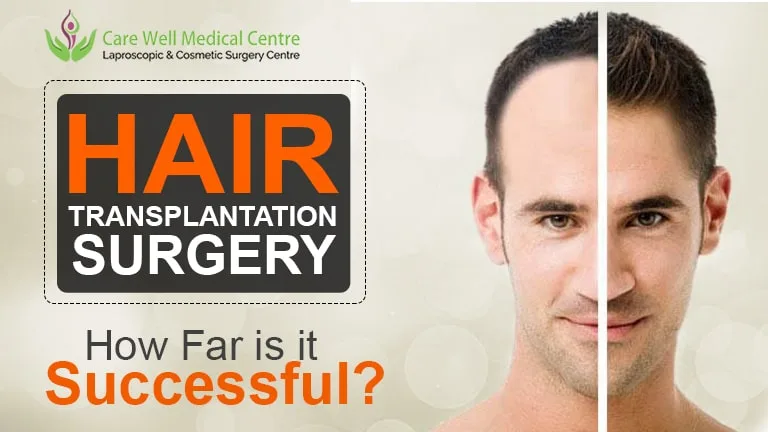How Really Successful is Hair Transplant Surgery? Then Decide