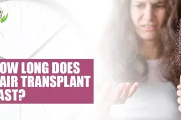 How Long Does Hair Transplant Last?